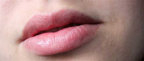 dudak çevresinde morarma neden olur